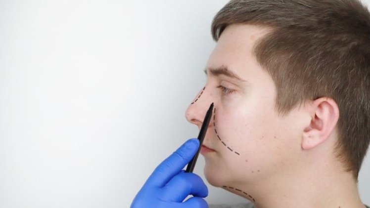 Enhancing Elegance: The Artistry Of Tip Rhinoplasty For A Subtle Transformation