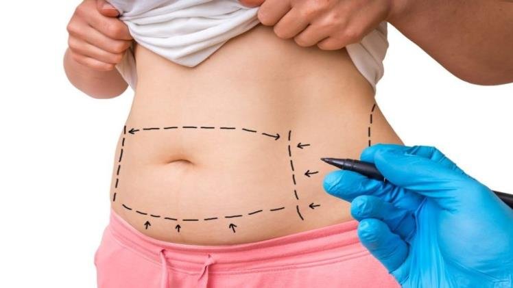 What Can A Mommy Makeover Correct?